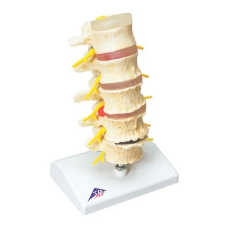 Fabrication Enterprises 3B Anatomical Model - Vertebrae Degeneration, Stages of Prolapsed Disc 12-4542
